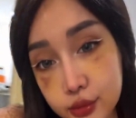 Masih bengkak dan memar