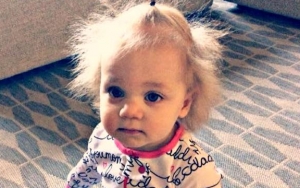 Derita Sindrom Rambut Langka, Bayi Ini Disebut Sebagai Einstein Mini