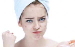 Cara Mudah Hilangkan Jerawat Dalam 1 Hari Hanya Pakai Bahan-Bahan Alami