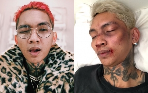 Young Lex Akhirnya Ngaku Wajah Babak Belur Cuma Bohong, Reaksi Netter di Luar Dugaan