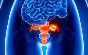 9 Tanda Awal Gejala Kanker Ovarium yang Sering Diabaikan Wanita