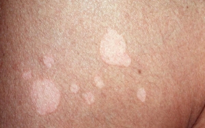 8 Cara Cepat Menghilangkan Panu dengan Bahan Alami