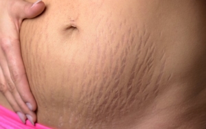 8 Tips untuk Menghilangkan Stretch Mark dengan Cepat