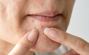 Ingin Bebas dari Masalah Kulit Wajah? Ini 10 Tips Dasar Mencegah Munculnya Jerawat