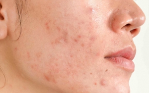 10 Tips Menghilangkan Bekas Jerawat dengan Bahan Alami yang Mudah Dijumpai