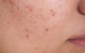 Samarkan Bekas Jerawat Dengan Memakai Baby Oil