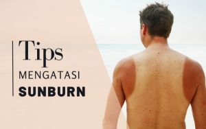 Bisa Sebabkan Kanker Kulit, Ikuti 7 Tips Mengatasi Sunburn Berikut Agar Sembuh Dengan Cara Tepat!