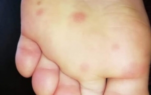 Riset di Spanyol Ungkap Kondisi Kaki Bisa Jadi Salah Satu Gejala Virus Corona 