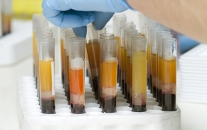 Terapi Plasma Darah Dilirik Jadi Obat Infeksi Corona, Seberapa Efektif?