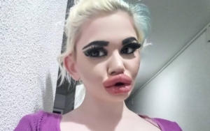 Dikira Monster, Wanita Ini Obsesi Punya Bibir Terbesar di Dunia Sampai Suntik Filler 20 Kali