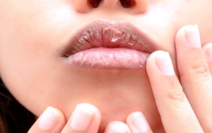 Waspada! Bibir Kering dan Pecah-pecah Bisa Jadi Gejala Terinfeksi COVID-19