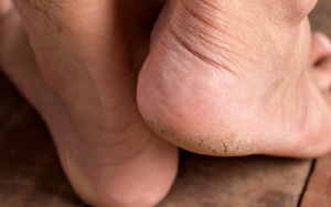 Tumit Kaki Pecah-Pecah Bikin Enggak Percaya Diri? Segera Atasi dengan 7 Bahan Alami yang Aman Ini