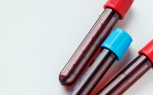 Bisa Obati Pasien COVID-19, Terapi Plasma Tetap Miliki Kelemahan Ini