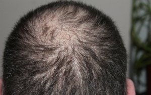 Pria di Singapura Alami Rambut Rontok Parah Usai Terima Vaksin Moderna, Ada Kaitannnya?