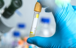 Kemenkes Laporkan Kasus Hepatitis Akut Misterius RI Kembali Bertambah, Kini Jadi 20