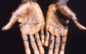 Endemik di Afrika, Kongo Hingga Nigeria Laporkan Kasus Kematian Akibat Cacar Monyet di Tahun 2022