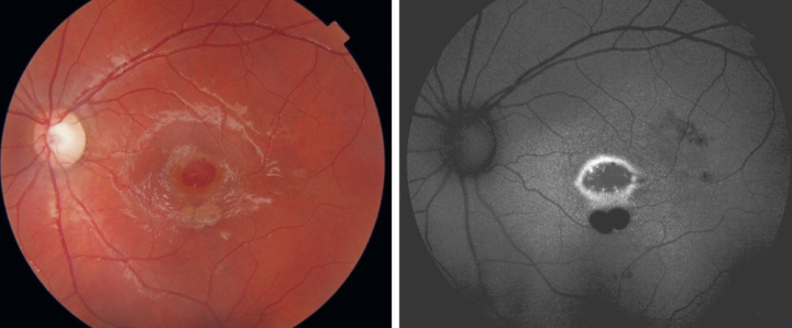 Retina Berlubang Karena Sinar Laser
