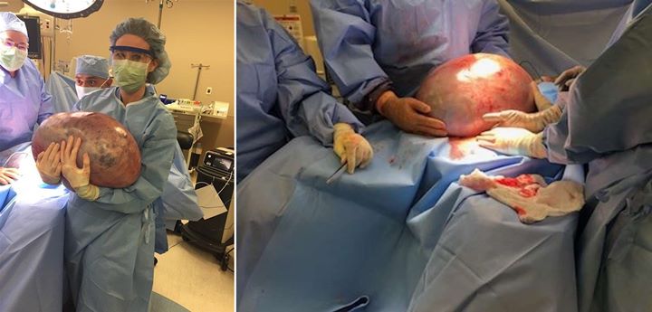 Dikira Hanya Kelebihan Berat Badan, Perempuan Ini Ternyata Punya Kista Ovarium Seberat 22 Kilogram