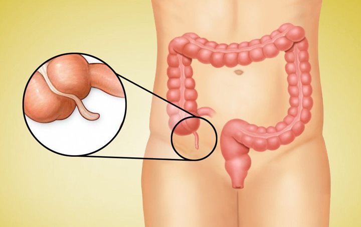 3. Usus Buntu