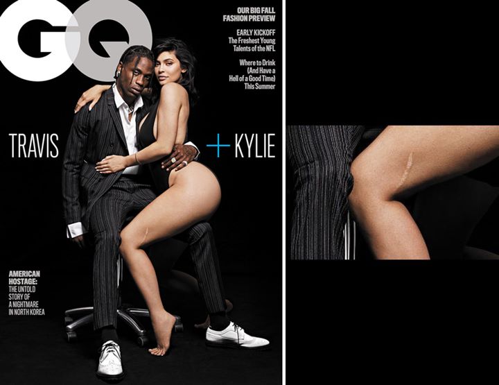 Bekas luka Kylie Jenner