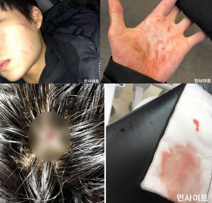 Sebarkan Foto-Foto Bagian Tubuh yang Luka, Teman Benarkan Chibin Dipukuli Member MASC Ini