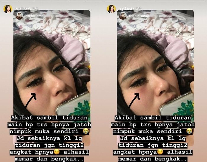 Mata Syahnaz Sadiqah Alami Bengkak dan Memar
