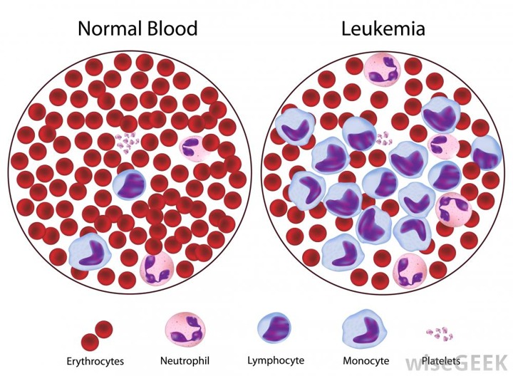 Bawang Merah untuk Penderita Leukimia