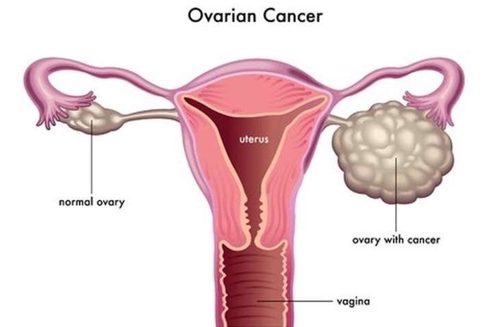Bawang Merah untuk Mengatasi Kanker Ovarium