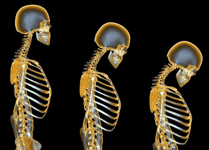 Susu Mencegah Osteoporosis pada Wanita