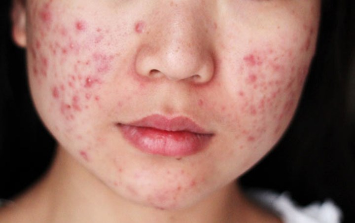 Kulit Sensitif Ditandai dengan Mudah Berjerawat