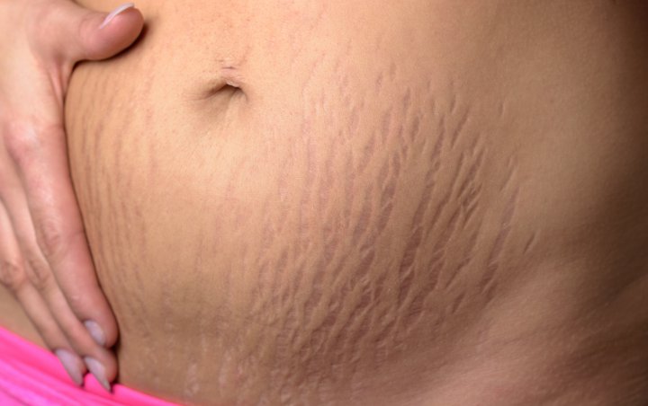 8 Tips untuk Menghilangkan Stretch Mark dengan Cepat