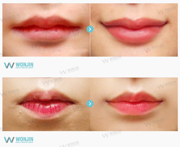 Operasi untuk Membuat Garis Bibir
