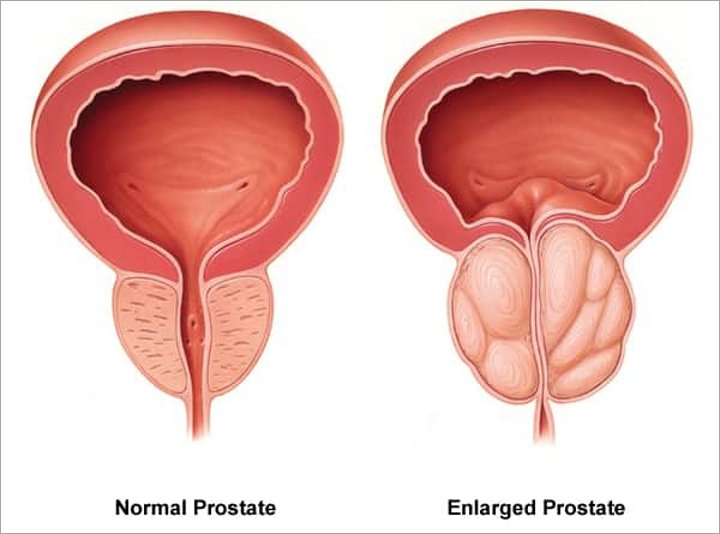 Penyakit prostat