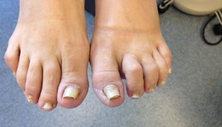 Onychomadesis (Kuku Jari Kaki Tumbuh Abnormal)