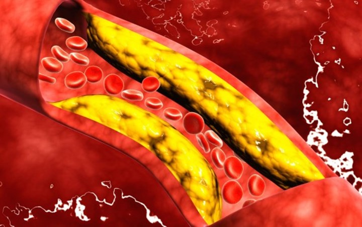 Daun Jambu Biji Berguna untuk Menurunkan Kolesterol