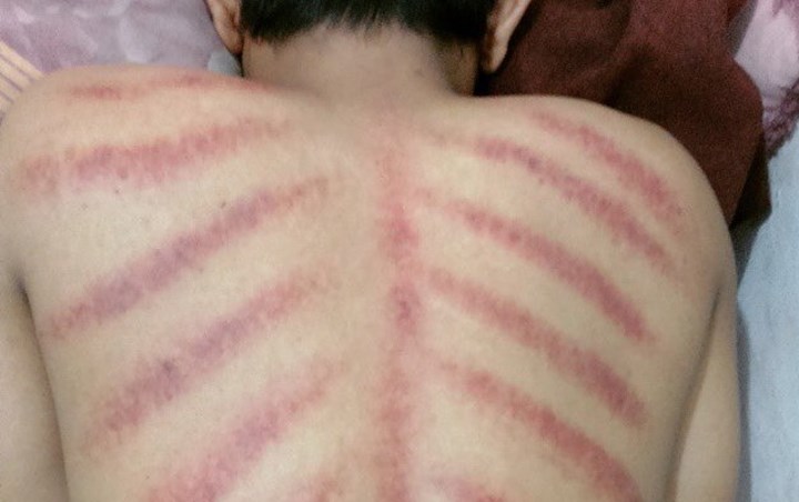 Kerokan Membuat Tubuh Menjadi Lebih Hangat
