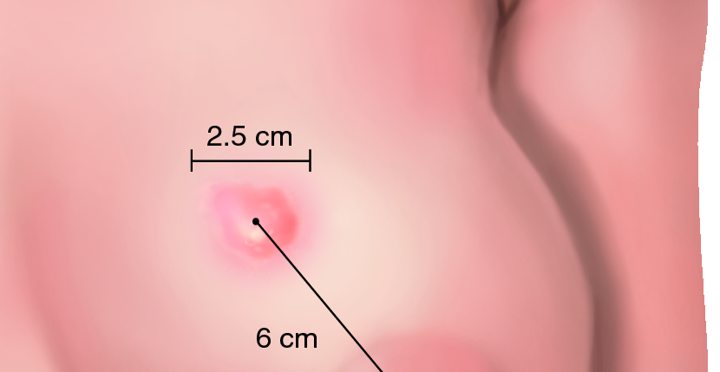 Waspadai Muncul Benjolan di Payudara 