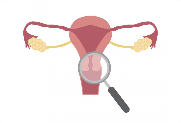 Keputihan Berlebihan Bisa Jadi Tanda Kanker Serviks
