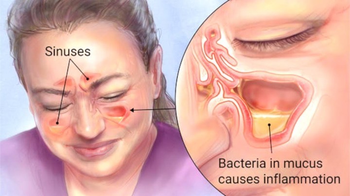 Ngiler Dapat Disebabkan Oleh Infeksi Sinus