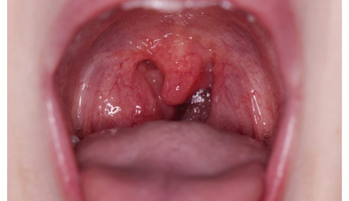 Infeksi Tonsilitis atau yang Lebih Dikenal dengan Amandel