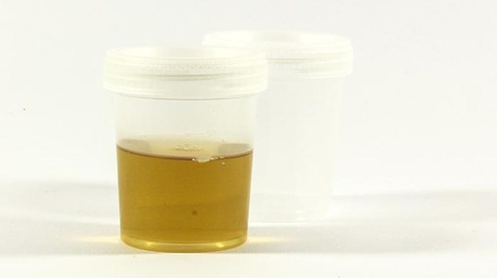 Warna Urine Menjadi Lebih Gelap