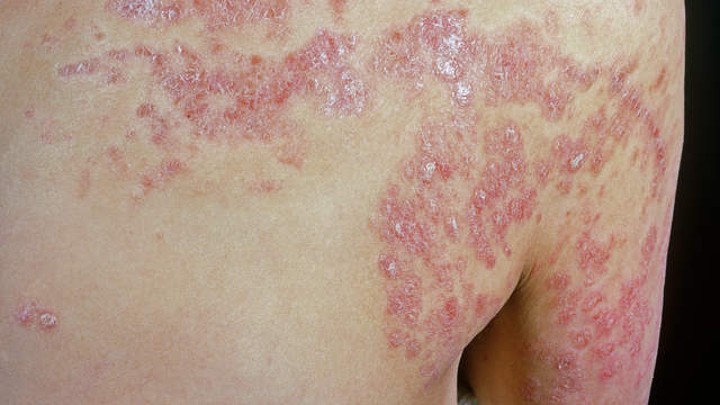 Penyakit Psoriasis Sebabkan Kulit Kering Bersisik