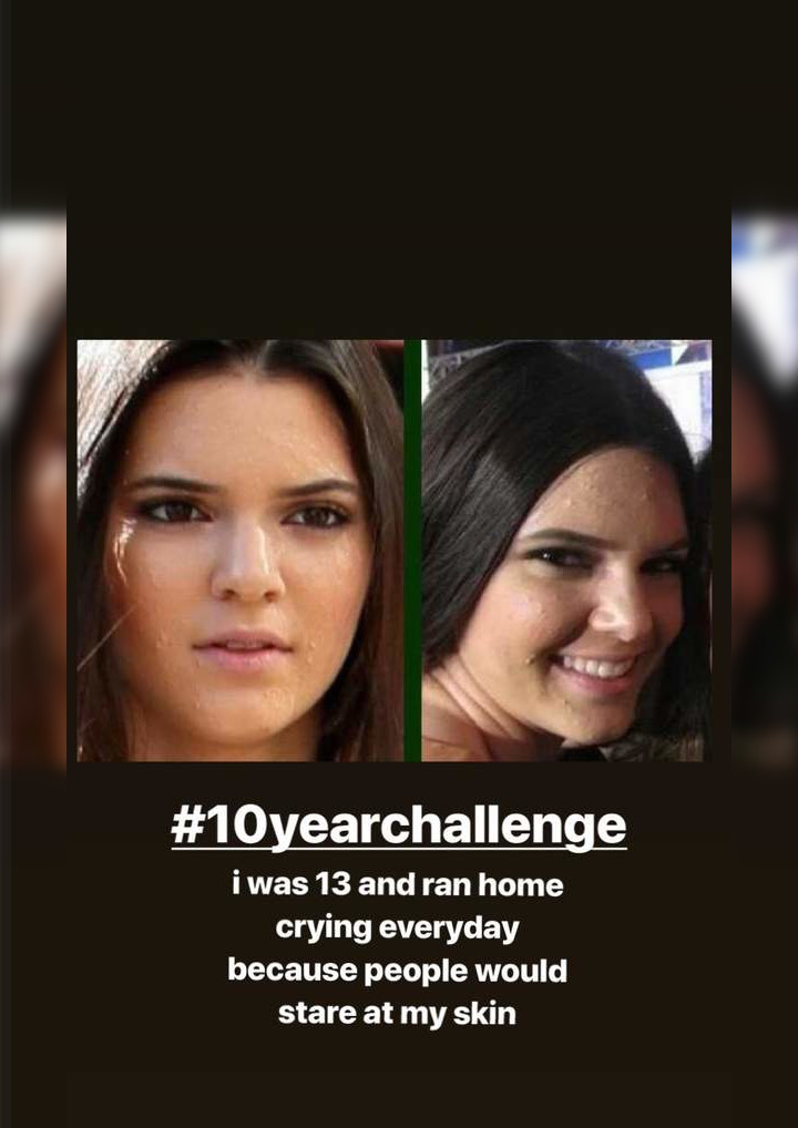 Kendall pamer wajah berjerawat