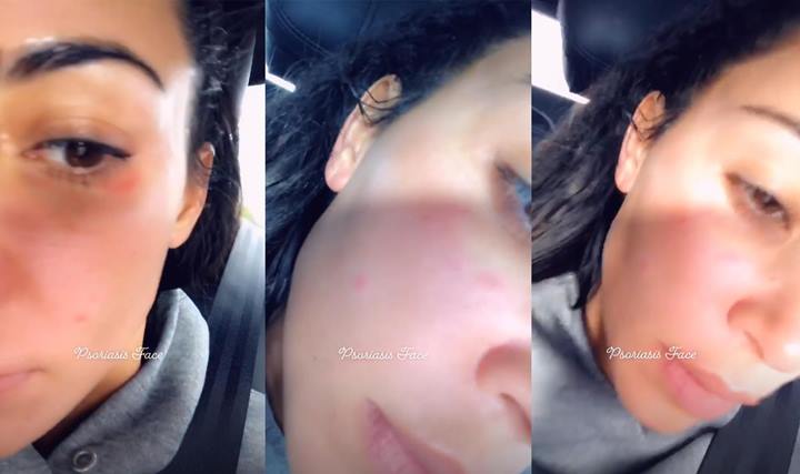 Kim Kardashian pamer kulit psoriasis