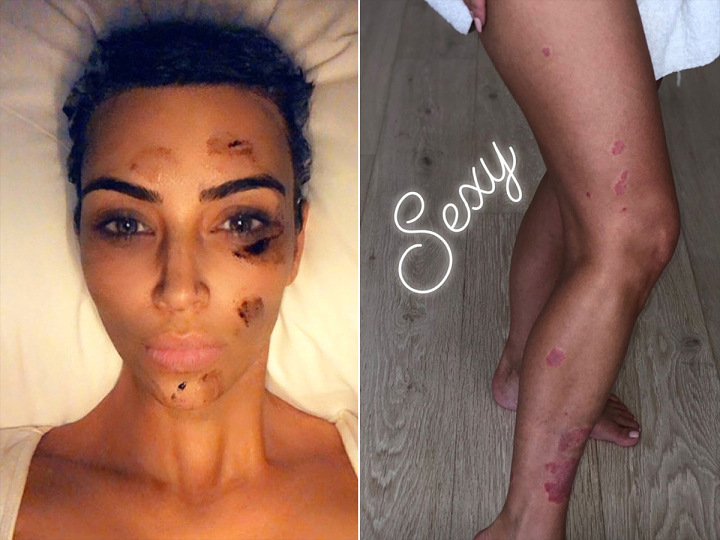 Kim Kardashian pamer kulit psoriasis