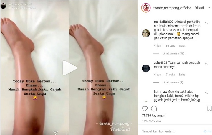 Syarini Lepas Perban, Kaki Masih Bengkak