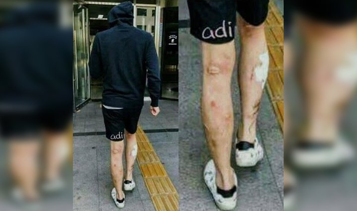 Yoochun Ngaku Pakai Narkoba, Foto Lawas Kaki Penuh Bekas Luka Bikin Jijik