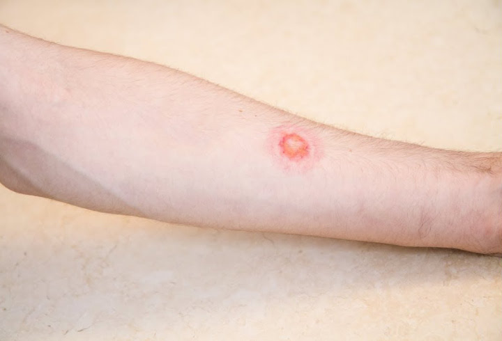 Ringworm Yang Ternyata Bukan Dari Cacing