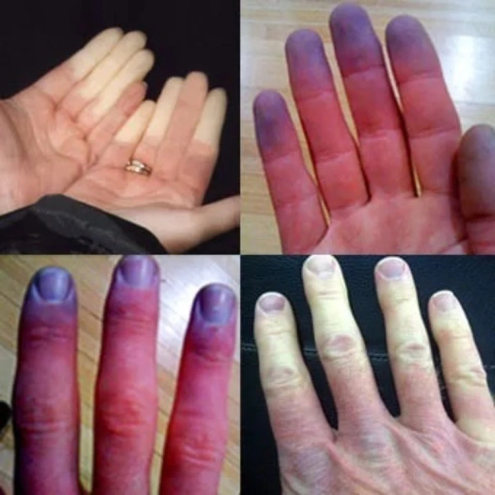 Sindrom Raynaud