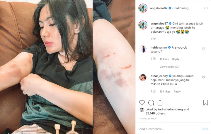 Angela Lee Pamer Luka Memar Jatuh Dari Tangga Komentar Khawatir Dinar Candy Disorot
